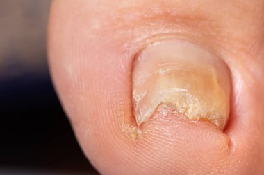 Ayak başparmağındaki çivi mantarı - dermatomikoz ve onyemikoz, mantar enfeksiyonu makro fotoğraf.