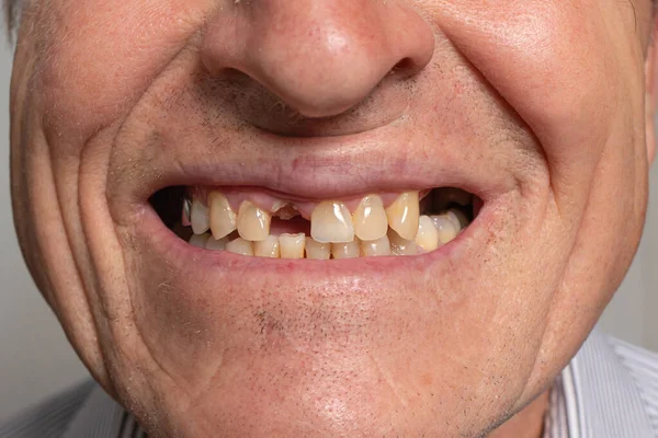 Sorriso Sem Dentes Velho Homem Europeu Sobre Fundo Cinzento Odontologia — Fotografia de Stock