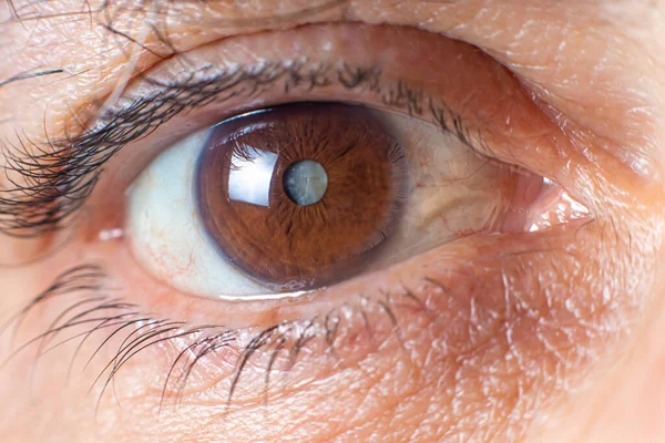 Fotos Macro Olho Humano Catarata Turvação Lente Deterioração Visão Tratamento — Fotografia de Stock