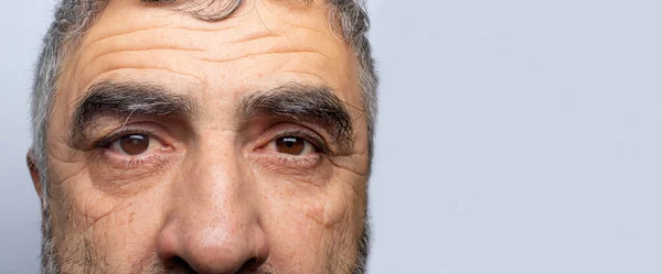 Homem Com Catarata Uma Doença Lente Olho Humano Nublando Comparação — Fotografia de Stock