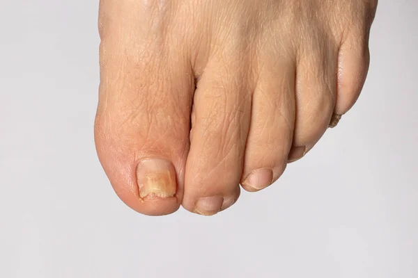 Fungo Unhas Dedo Grande Dermatomicose Onicomicose Infecção Fúngica Foto Macro — Fotografia de Stock