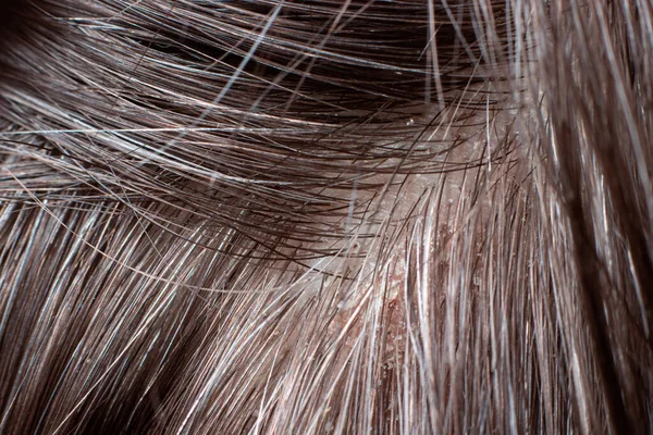 Macro foto de cabello humano con caspa. Heridas en la cabeza y picor, cuidado del cabello, tratamiento seborreico — Foto de Stock
