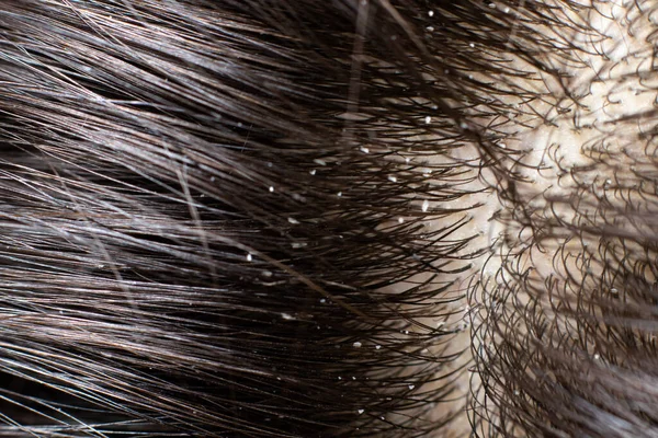 Macro foto caspa en cabello moreno oscuro. El problema del cuero cabelludo seco, champú equivocado, hongos en la cabeza — Foto de Stock