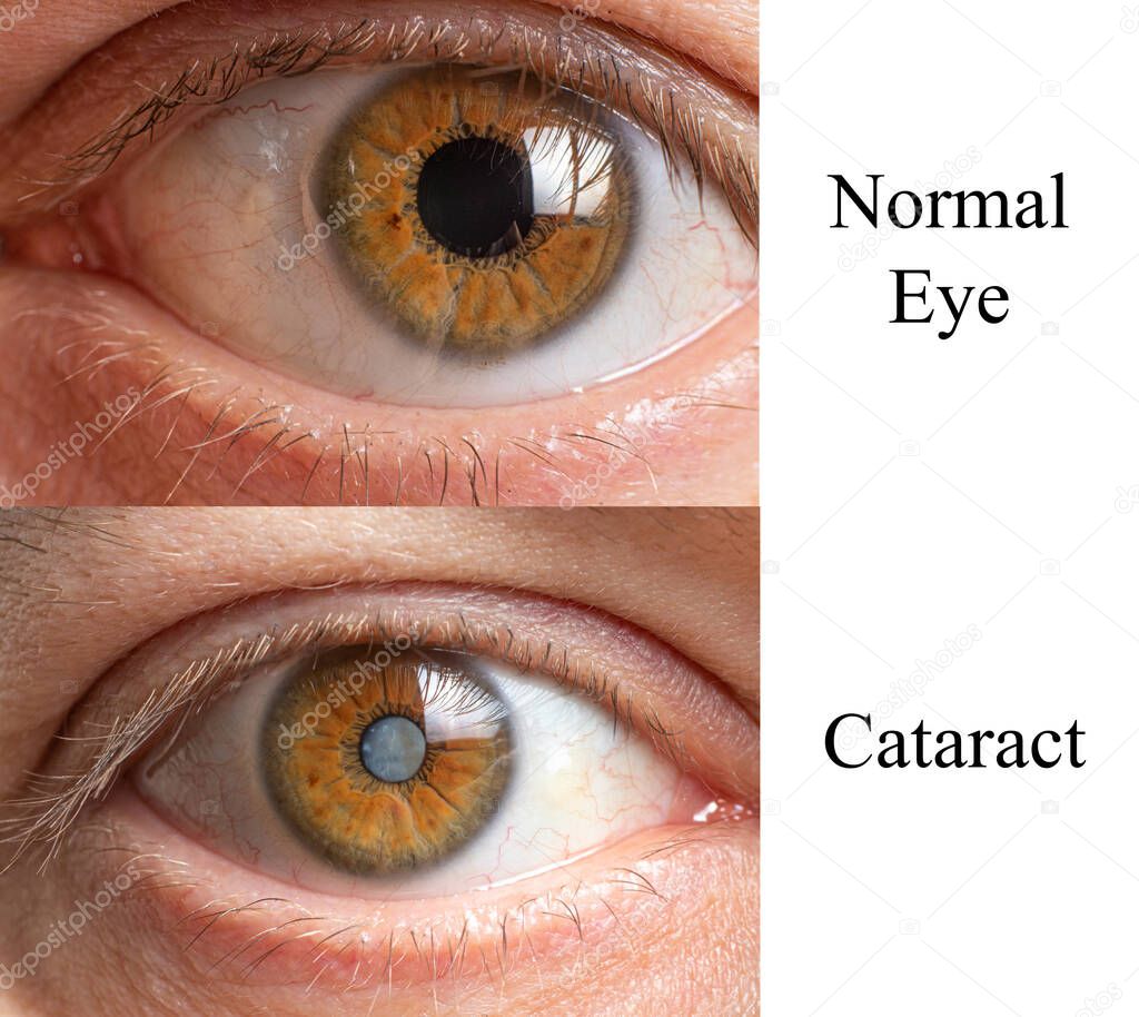 Comparison of a healthy human eye and an eye with a clouded lens cataract