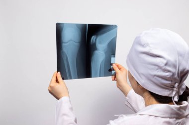 Doktor ya da radyoloji uzmanı birinin bacağının röntgenini çeker. Diz, diz yaralanması. Kırık ya da kemik kırığı teşhisi.