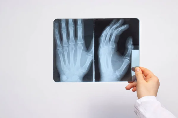 Doctor Radiologist Holds Ray Patient Hand Injury Diagnosis Fractures Fractures — Stock Photo, Image