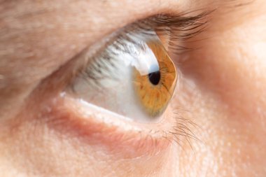 Keratoconus gözü, 4. derece. Korneanın koni şeklinde bükülmesi, görme bozukluğu, astigmatizm. Makro, kapat..