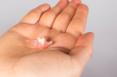 Bir insanın elindeki yapay diş protezi. Gerçek bir dişin yerine çıkarılabilir tek bir protez diş implantasyonuna alternatif..