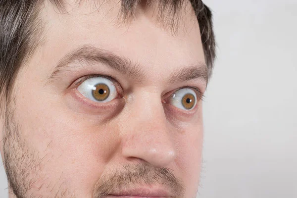 Un hombre de ojos abiertos con enfermedad de Graves bocio difuso tóxico, hipertiroidismo. Glándula tiroides agrandada y ojos saltones de exoftalmos. Enfermedad del sistema endocrino, endocrinología. — Foto de Stock