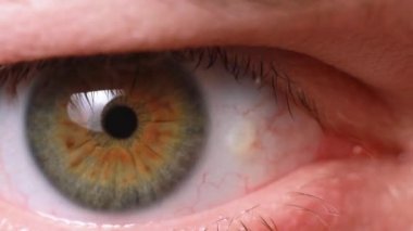 Pinguecula 'nın gözleri, erkek gözünün makro görüntüsü. Sincap üzerinde sarı eğitim, çiftçi gözü.