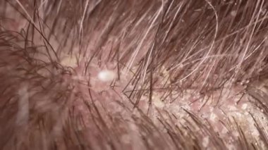 Kepekli insan saçının makro videosu. Kafa yaraları ve kaşıntı, saç bakımı, seboreik tedavi