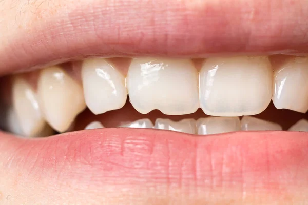 Macro close-up of human teeth. Shows the chipped tooth. The effect of the cutters tooth from biting the seeds shell and solid food. For dentists, dental clinics - aesthetic minor damage. — Stock Photo, Image