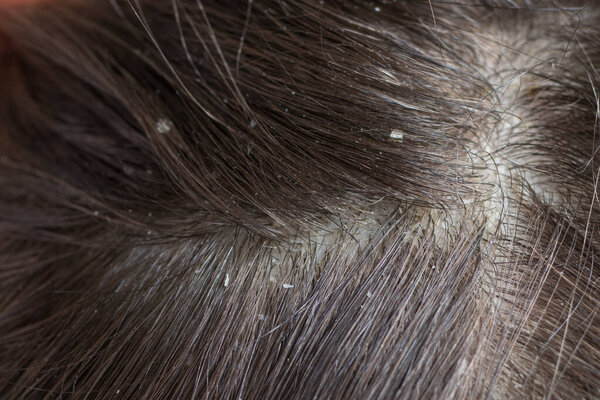Макро фото человеческих волос с перхоти. Раны головы и зуд, уход за волосами, себорейное лечение.