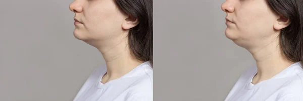 Kobieta Podwójny Podbródek Przekształcanie Podbródka Usuwanie Tłuszczu Podnoszenie Porównanie Kolażu — Zdjęcie stockowe