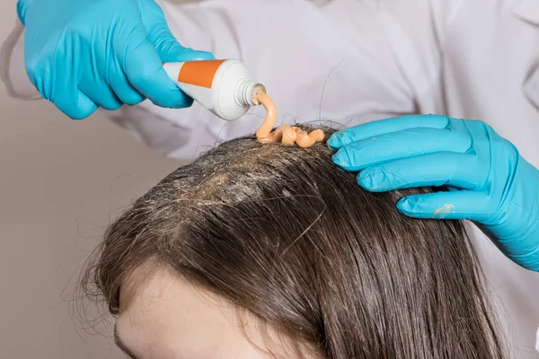 A dermatologist or trichologist applies a dandruff or lice weed to the patients hair. Treating psoriasis, hair loss, dermatitis or head lice. — Stock Photo, Image