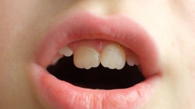 Kalabalık dişli çocuk. Sekiz yaşındaki bir çocuğun ağzında eğri büğrü, kalıcı ve bebek dişleri.