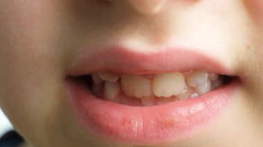 Çürük dişleri, kalabalık dişleri, pediatrik dişleri olan bir çocuğun gülümsemesi..