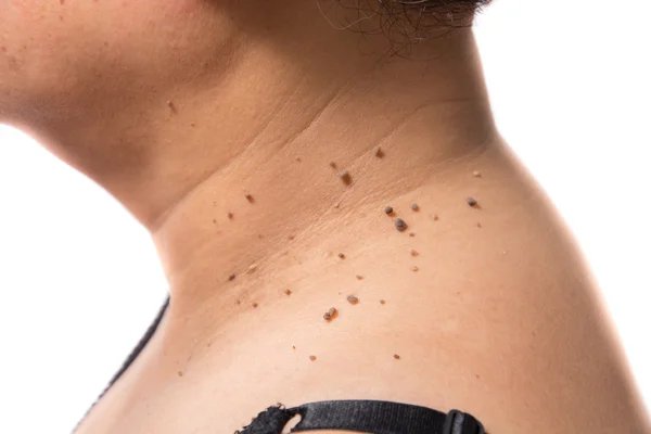 Skin of a woman with moles — Stock Photo, Image
