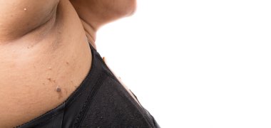 Bir kadının mol ile cilt