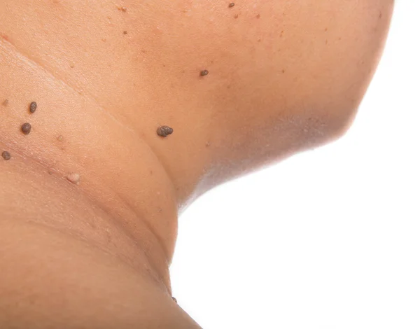 Skin of a woman with moles — Stock Photo, Image