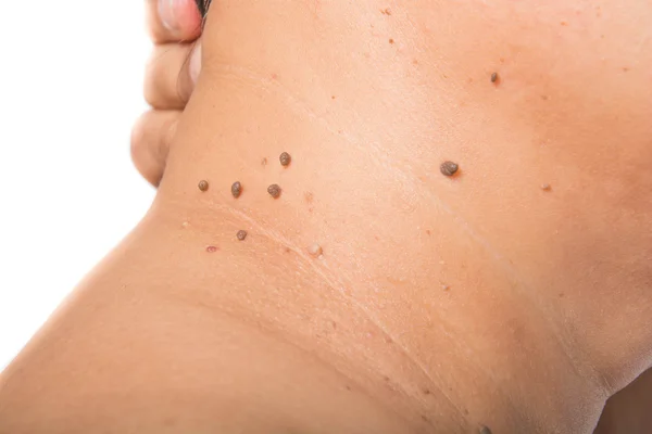 Skin of a woman with moles — Stock Photo, Image