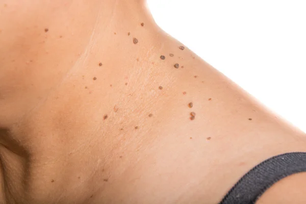 Skin of a woman with moles — Stock Photo, Image