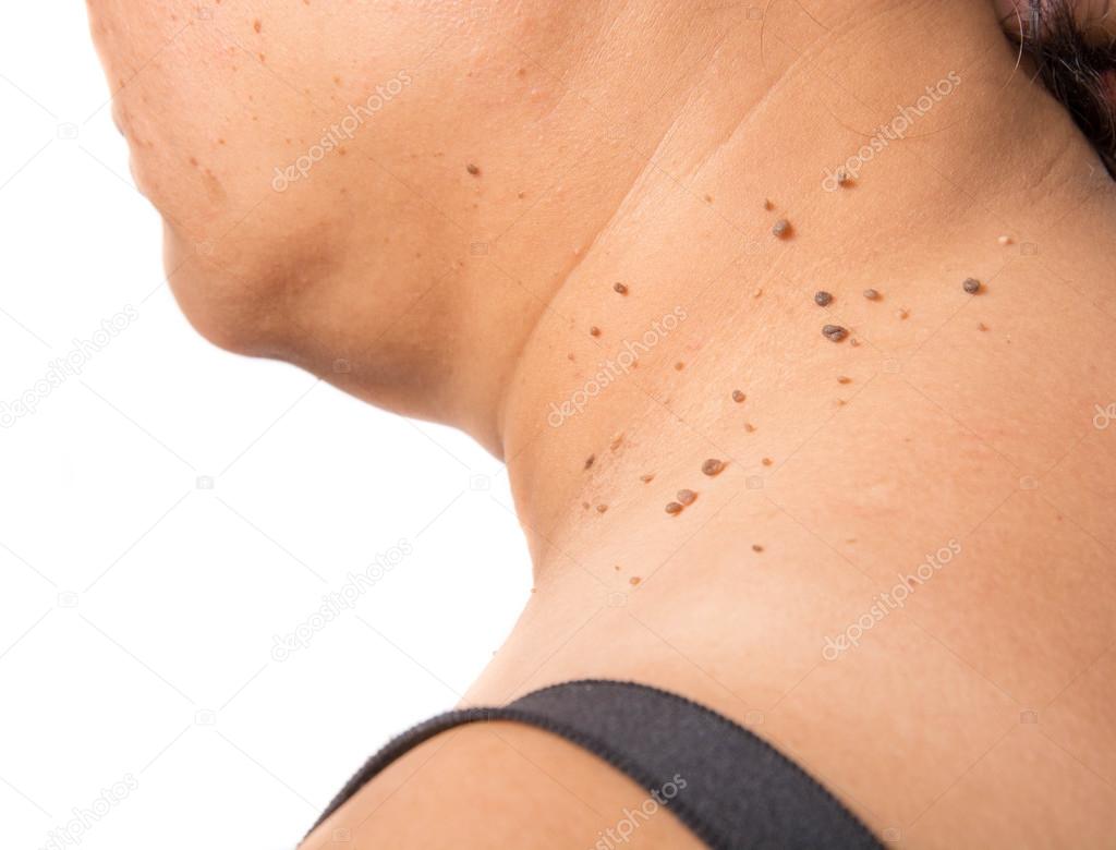 skin of a woman with moles