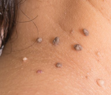 skin of a woman with moles clipart