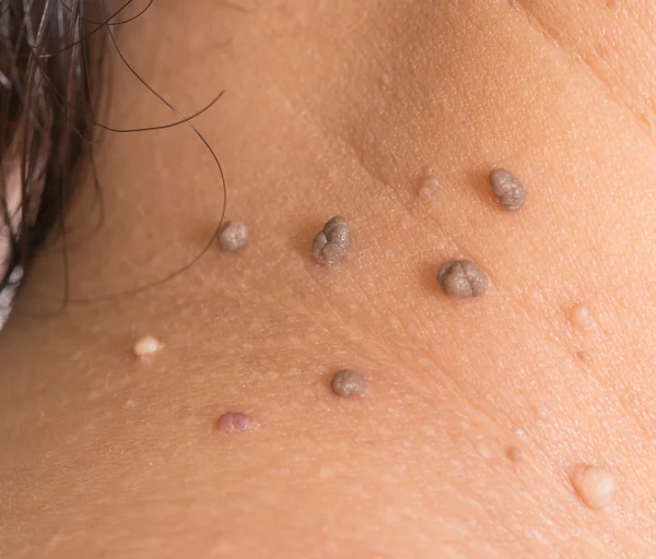 Skin of a woman with moles — Stock Photo, Image
