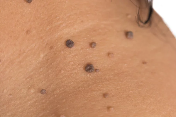 Skin of a woman with moles — Stock Photo, Image