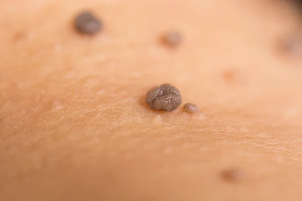 Skin of a woman with moles — Stock Photo, Image