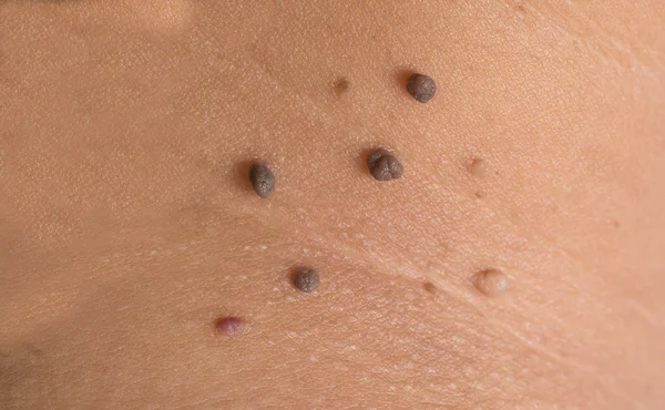 Skin of a woman with moles Royalty Free Stock Photos