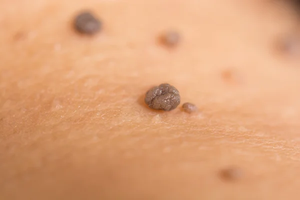 Skin of a woman with moles Stock Image