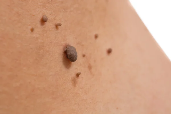 Skin of a woman with moles — Stock Photo, Image