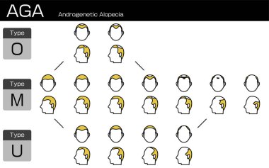 AGA androgenetik alopecia ve ilerleme aşamasının her türünün çizimi