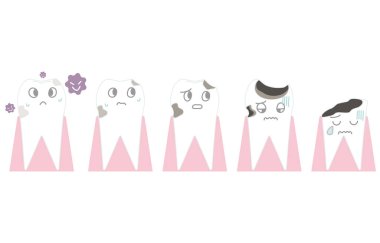 Diş çürüğünün gelişimi.