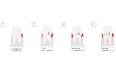 Periodontal hastalık ilerleme çizelgesi, 4 aşama