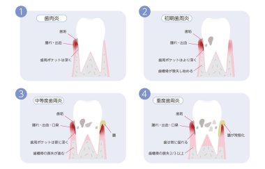 Periodontal hastalık ilerleme çizelgesi, 4 aşama