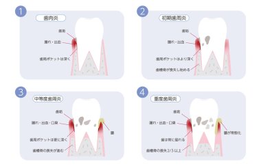 Periodontal disease progression illustration, 4 stage clipart
