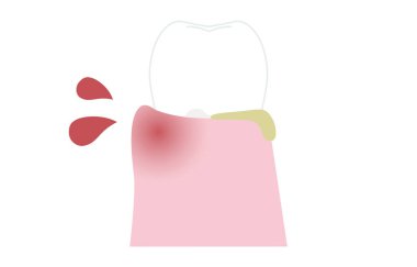 Periodontal hastalığın aşama aşaması: orta dereceli periodontit