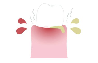 Periodontal hastalığın aşama aşaması: şiddetli periodontit