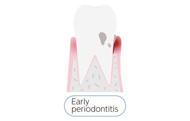 Periodontal hastalığın evresi: erken periodontit