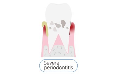 Periodontal hastalığın aşama aşaması: şiddetli periodontit