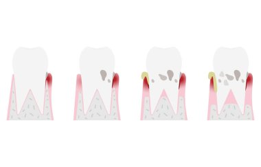 Periodontal hastalığın aşama aşaması: ilerleme düzeni