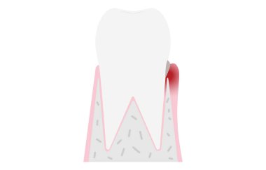 Periodontal hastalığın aşaması: diş eti iltihabı