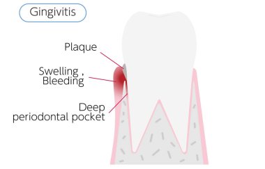 Periodontal hastalığın aşaması: diş eti iltihabı