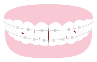 Estetik dişçilik ve ortodonti: Bozuk diş düzenleme ve metal parantez