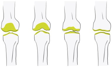 Dizdeki osteoartrit akışının temsili daha kötüdür.