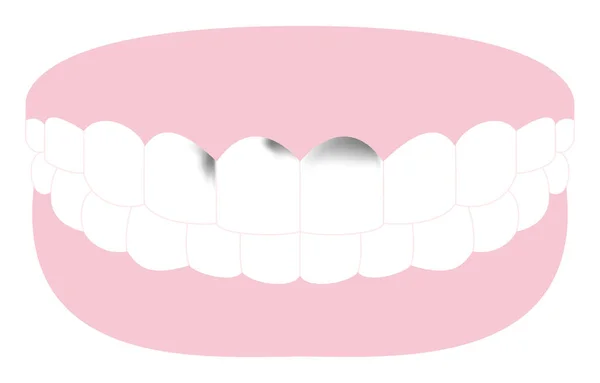 Εικονογράφηση Δοντιού Αποσύνθεση Προχωρημένη Στα Μπροστινά Δόντια — Διανυσματικό Αρχείο