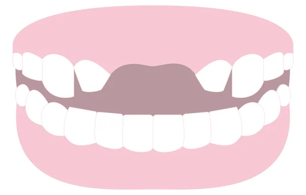 Ilustração Dente Afiado Ponte Dos Dentes Anteriores — Vetor de Stock